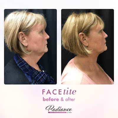 FaceTite Before & After Gallery - Patient 86641395 - Image 1