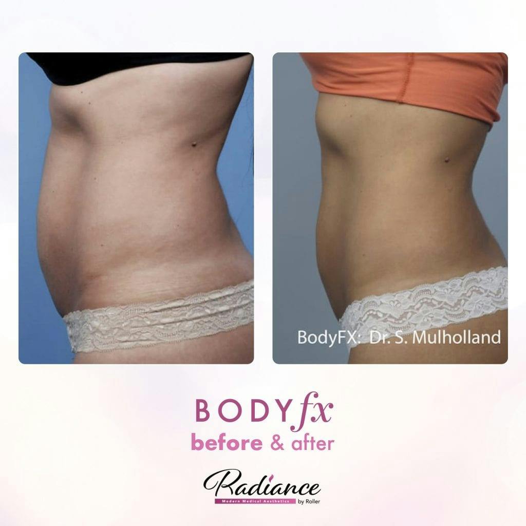 BodyFx Before & After Gallery - Patient 86641398 - Image 1