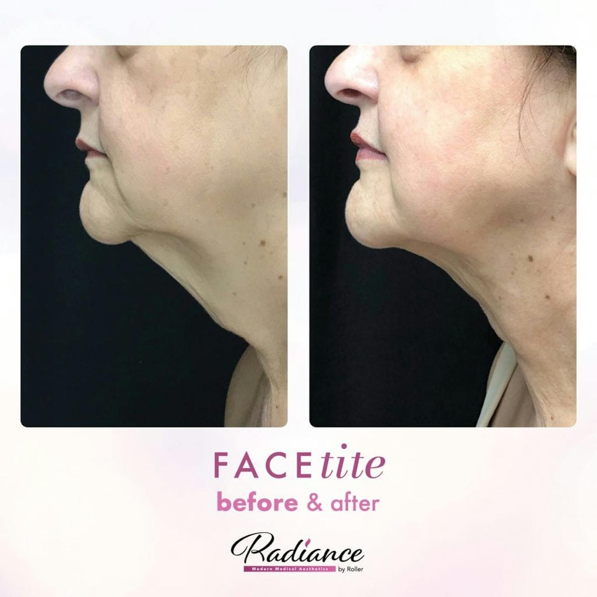 FaceTite Before & After Gallery - Patient 86641399 - Image 1