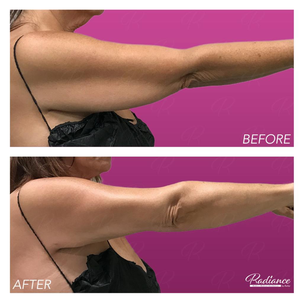 BodyTite Before & After Gallery - Patient 86641396 - Image 2