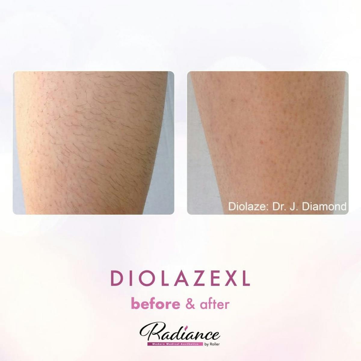 DiolazeXL Before & After Gallery - Patient 86641400 - Image 1