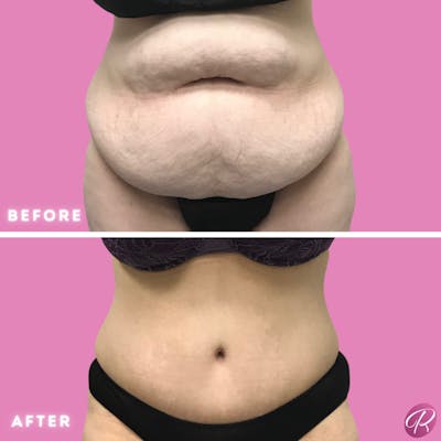 Tummy Tuck and Abdominoplasty Before & After Gallery - Patient 86641404 - Image 1