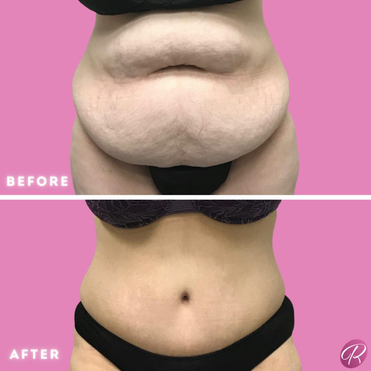 Tummy Tuck and Abdominoplasty Before & After Gallery - Patient 86641404 - Image 1