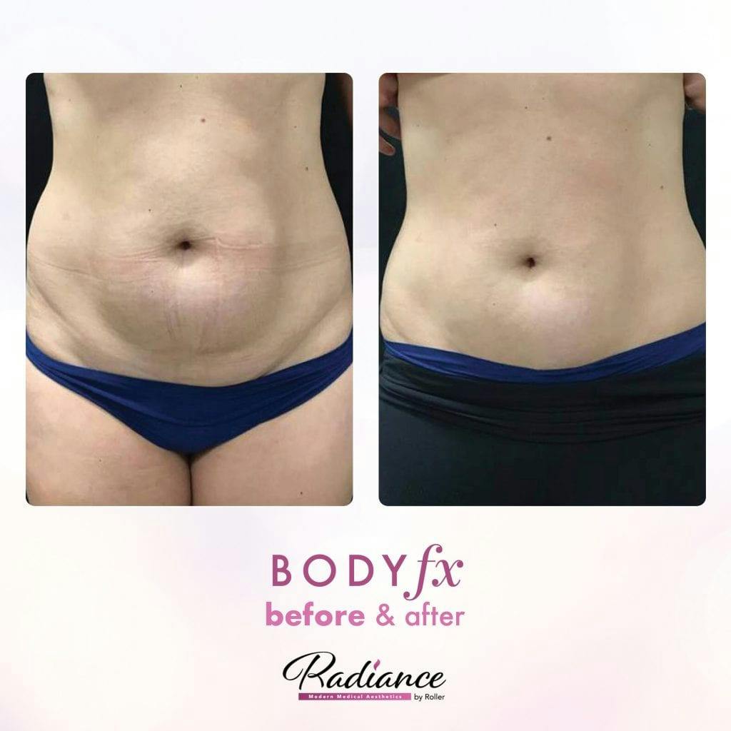Tummy Tuck and Abdominoplasty