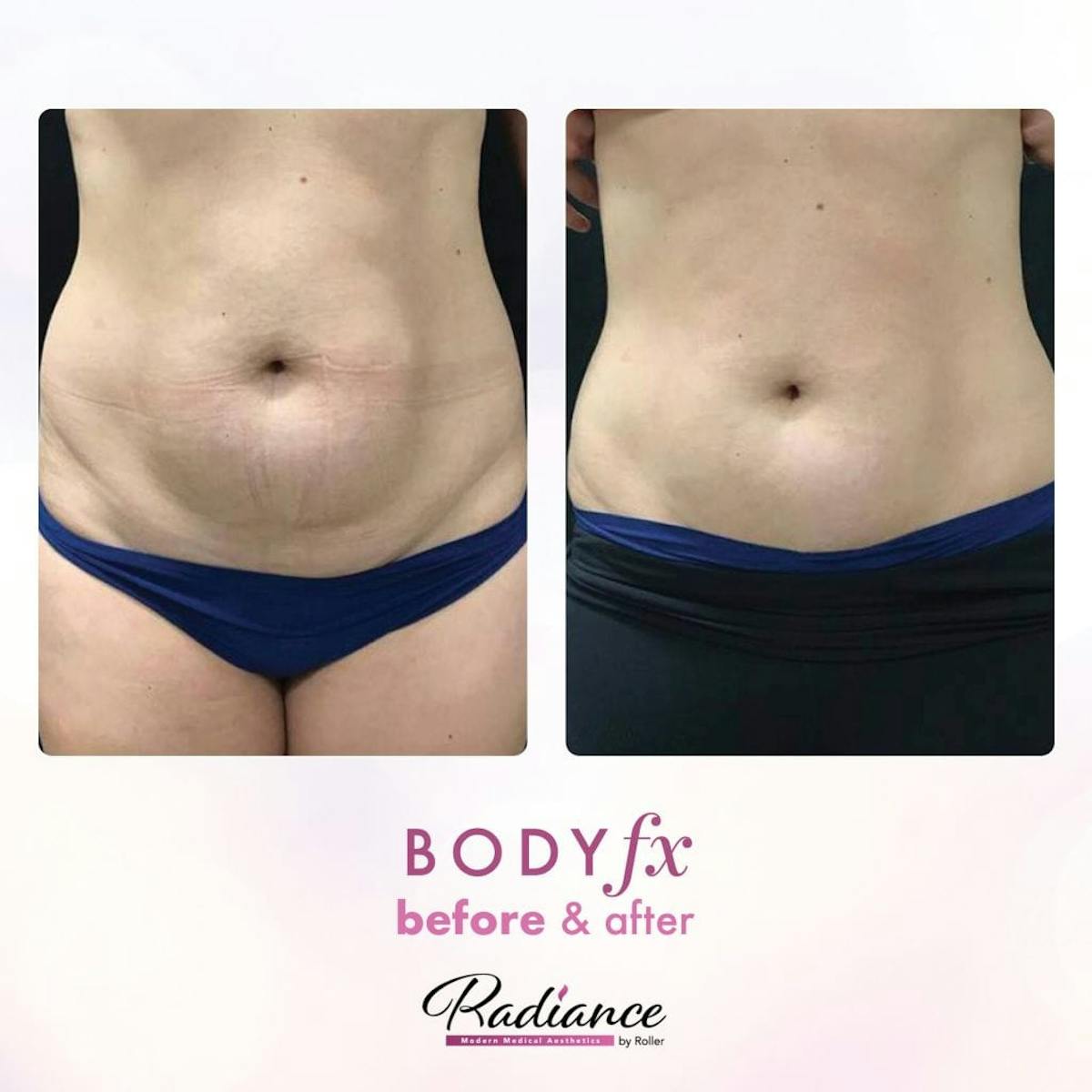 BodyFx Before & After Gallery - Patient 86641401 - Image 1