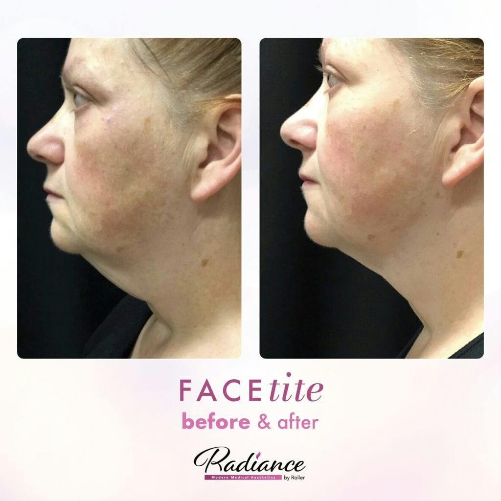 FaceTite Before & After Gallery - Patient 86641403 - Image 1