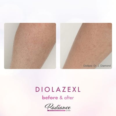 DiolazeXL Before & After Gallery - Patient 86641405 - Image 1