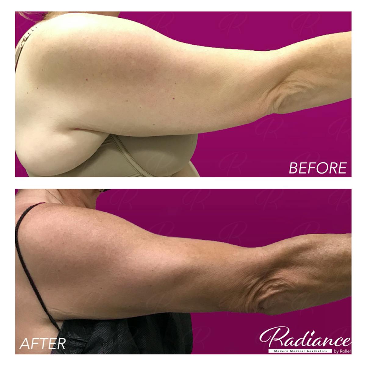 BodyTite Before & After Gallery - Patient 86641407 - Image 1