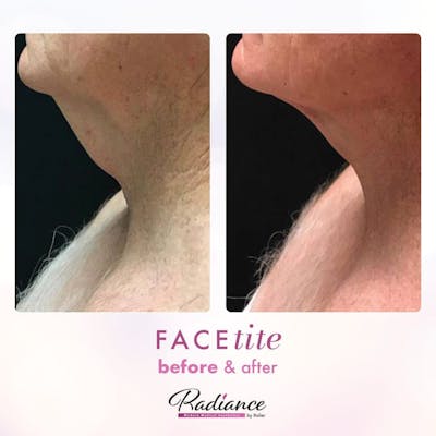 FaceTite Before & After Gallery - Patient 86641406 - Image 1