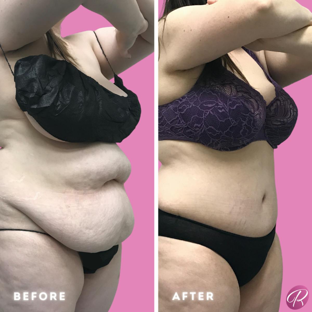 Tummy Tuck and Abdominoplasty Before & After Gallery - Patient 86641404 - Image 2
