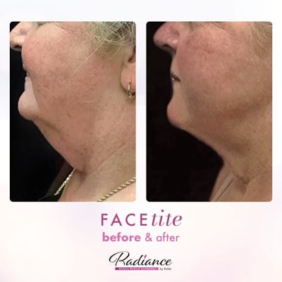 FaceTite Before & After Gallery - Patient 86641408 - Image 1