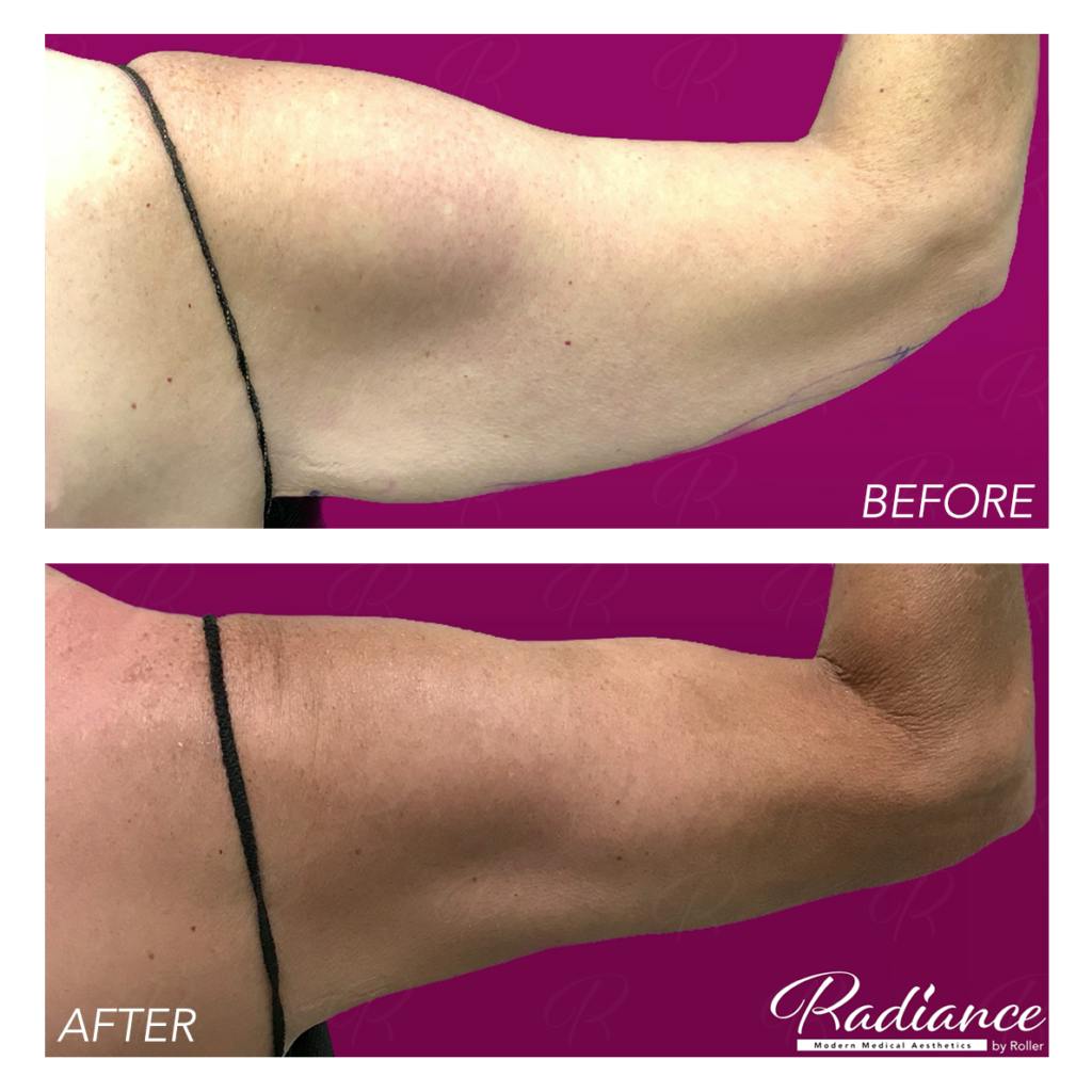 BodyTite Before & After Gallery - Patient 86641407 - Image 2