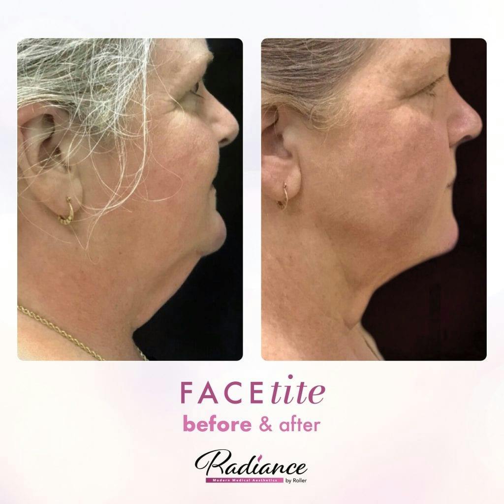 FaceTite Before & After Gallery - Patient 86641410 - Image 1