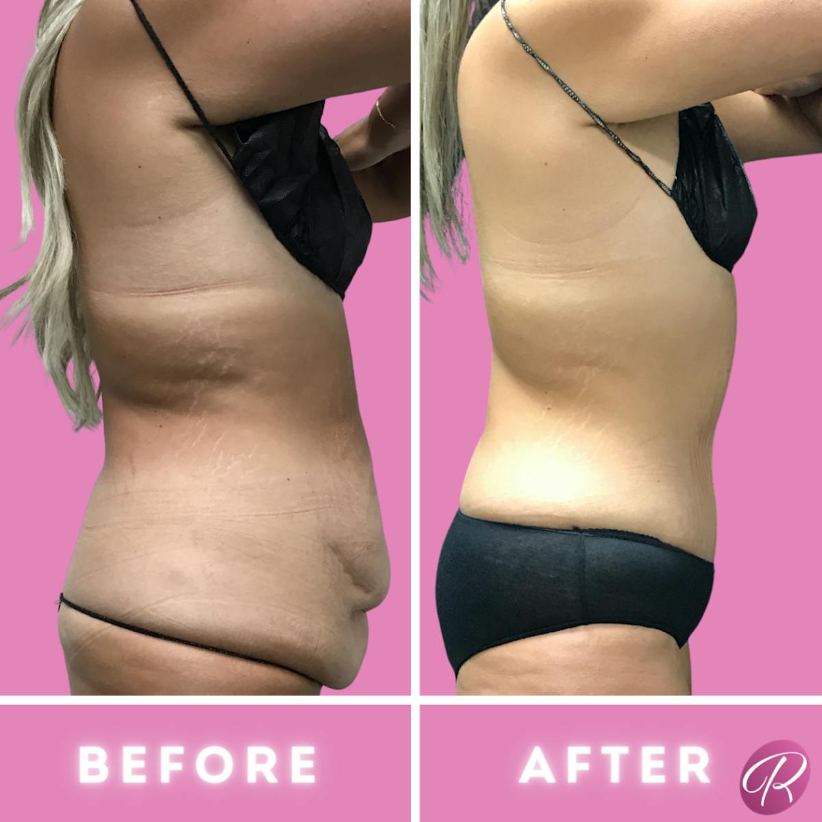 Tummy Tuck and Abdominoplasty Before & After Gallery - Patient 86641412 - Image 1