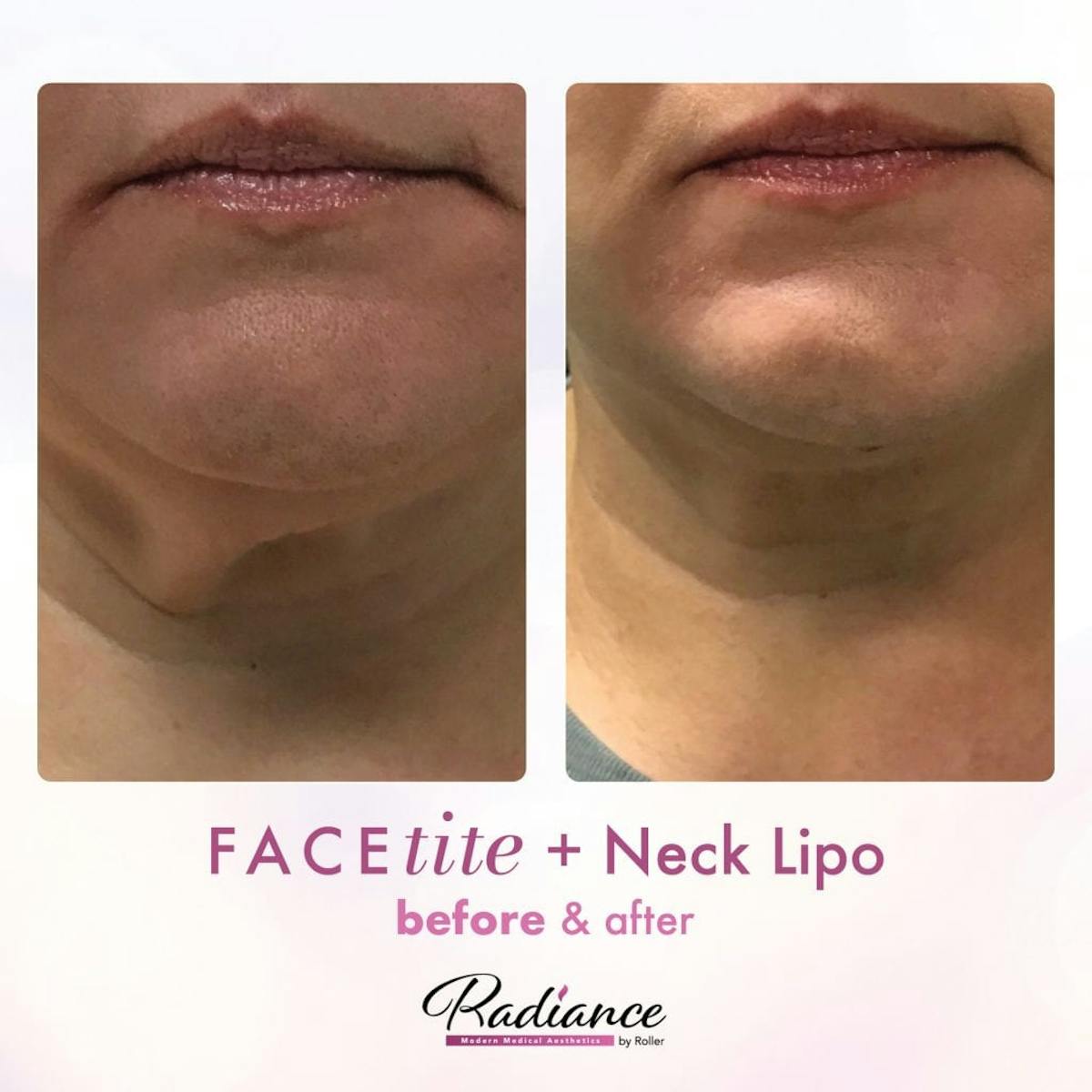 FaceTite Before & After Gallery - Patient 86641413 - Image 1