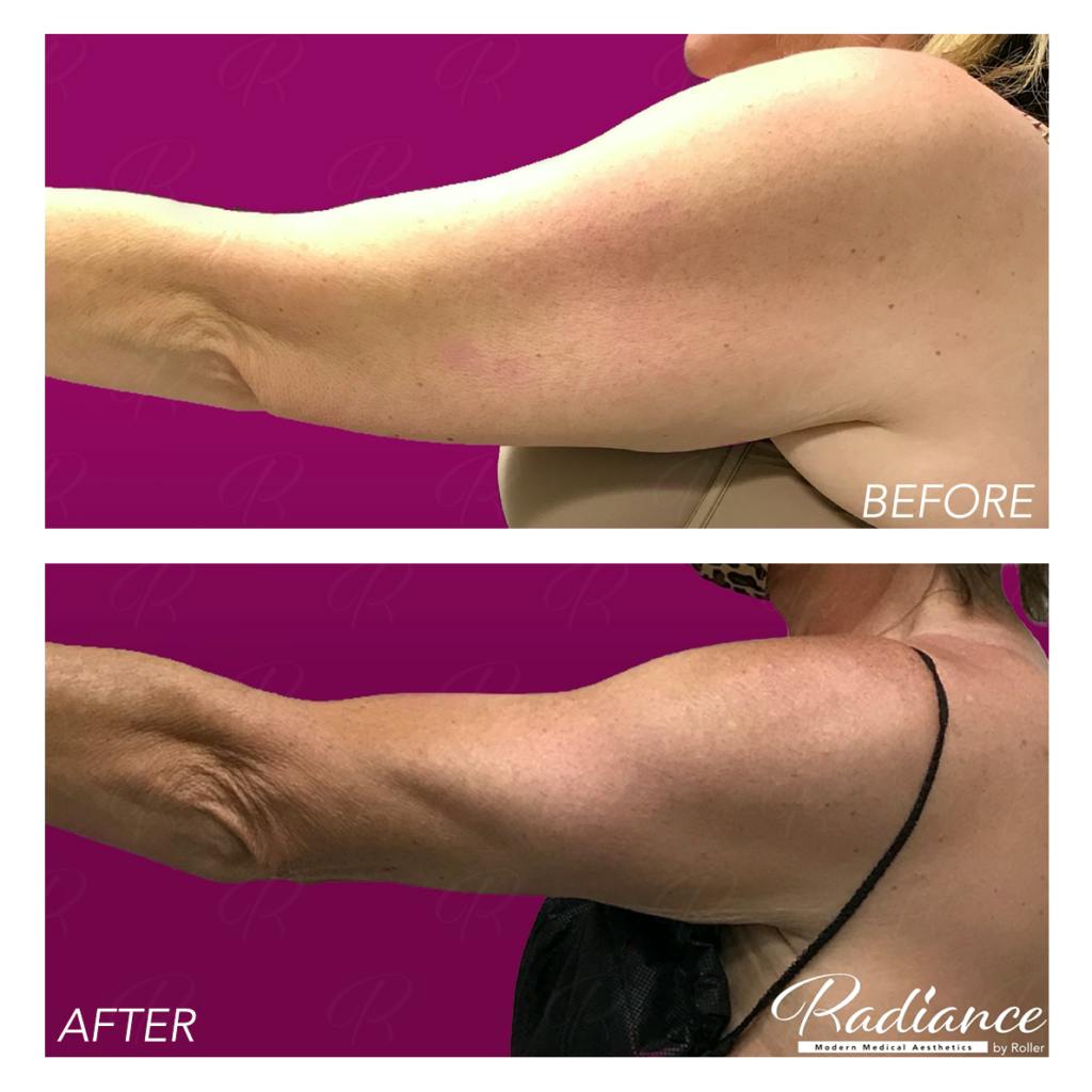 BodyTite Before & After Gallery - Patient 86641407 - Image 3