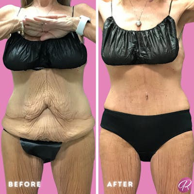 Tummy Tuck and Abdominoplasty Before & After Gallery - Patient 86641417 - Image 1