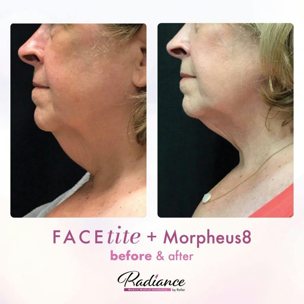 FaceTite Before & After Gallery - Patient 86641415 - Image 1