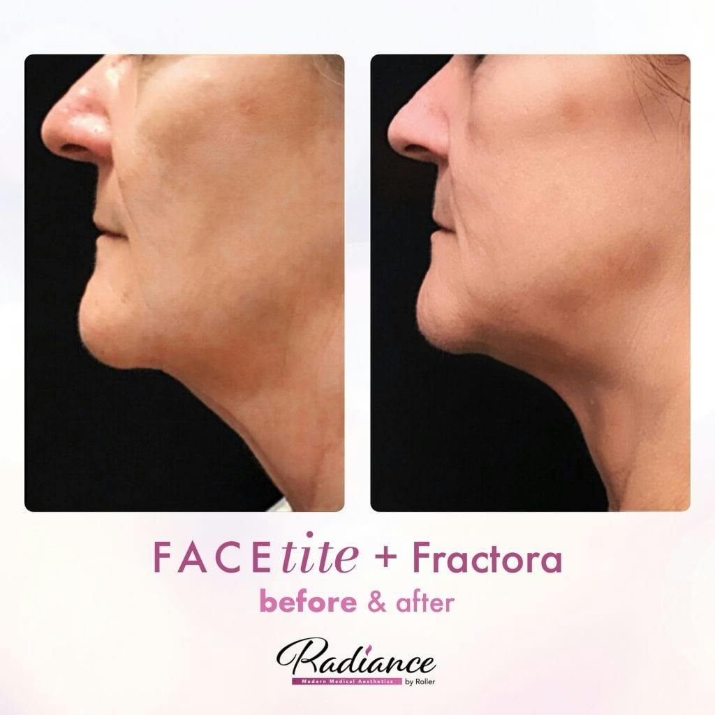 FaceTite Before & After Gallery - Patient 86641418 - Image 1