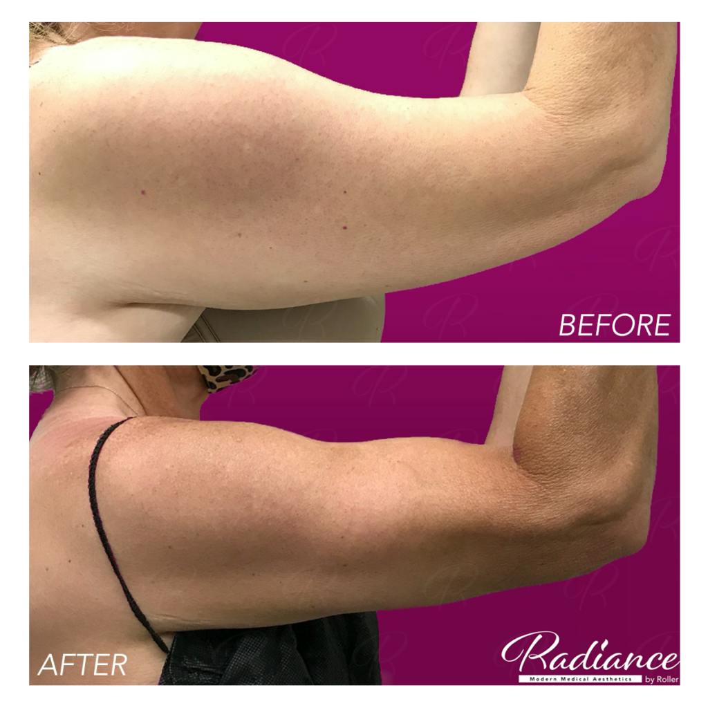 BodyTite Before & After Gallery - Patient 86641407 - Image 4