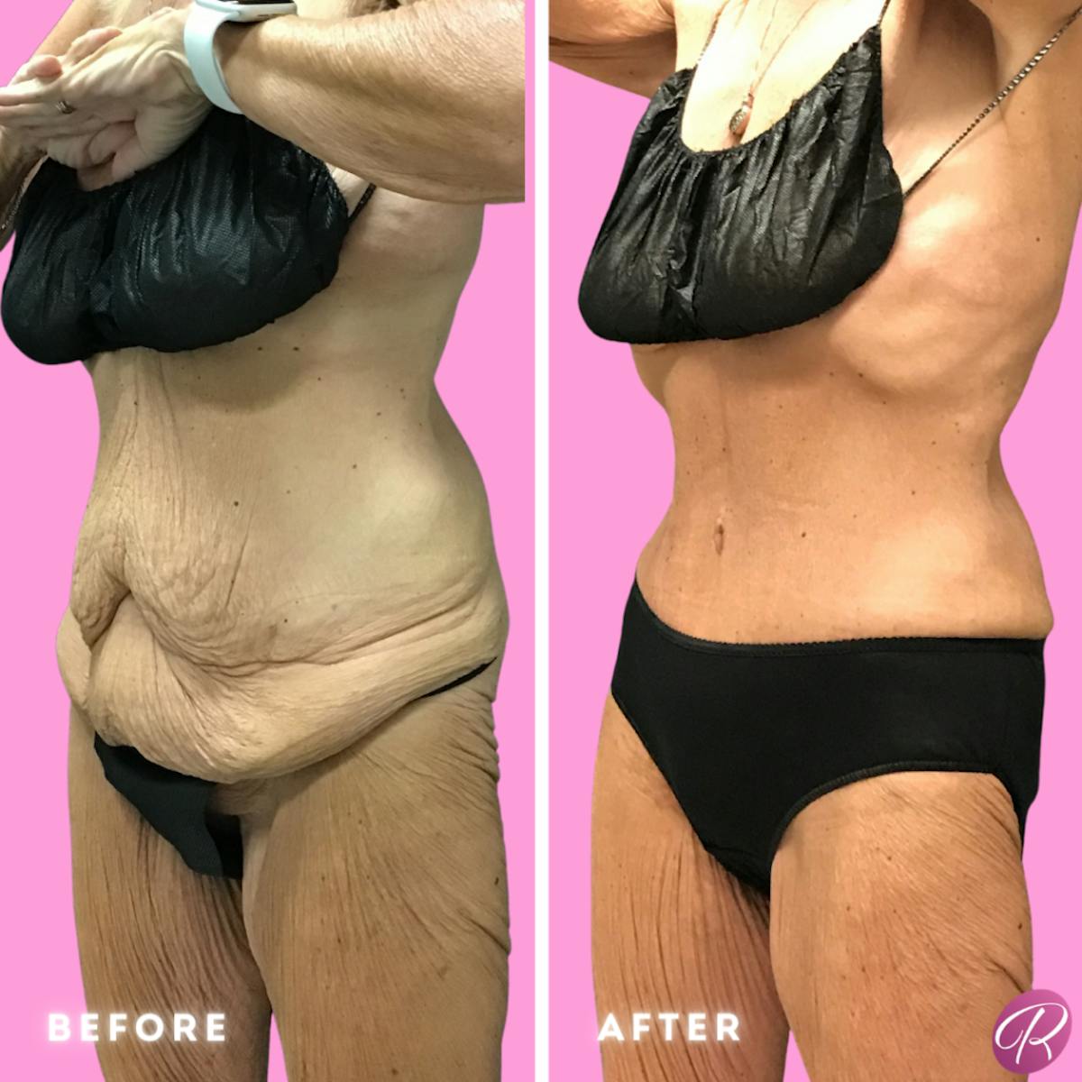 Tummy Tuck and Abdominoplasty Before & After Gallery - Patient 86641417 - Image 2