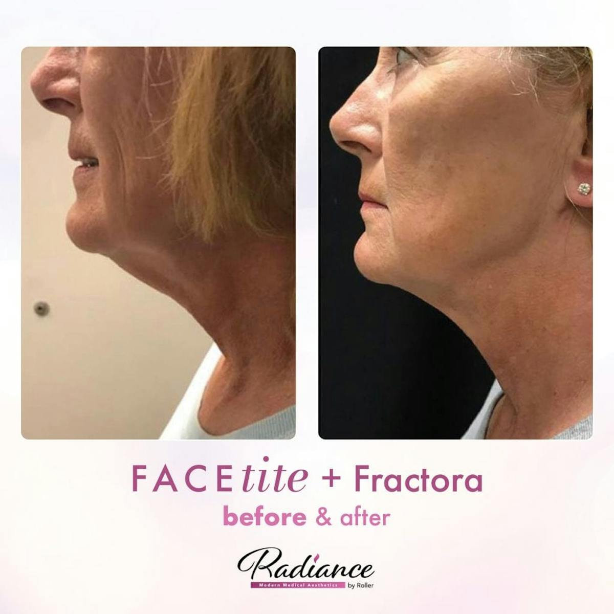 FaceTite Before & After Gallery - Patient 86641421 - Image 1