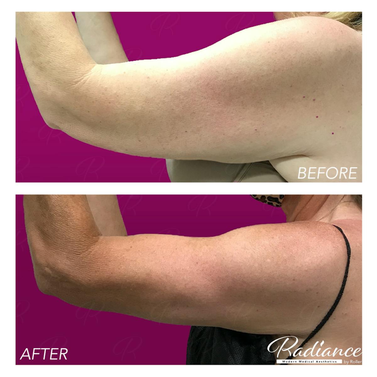BodyTite Before & After Gallery - Patient 86641407 - Image 5