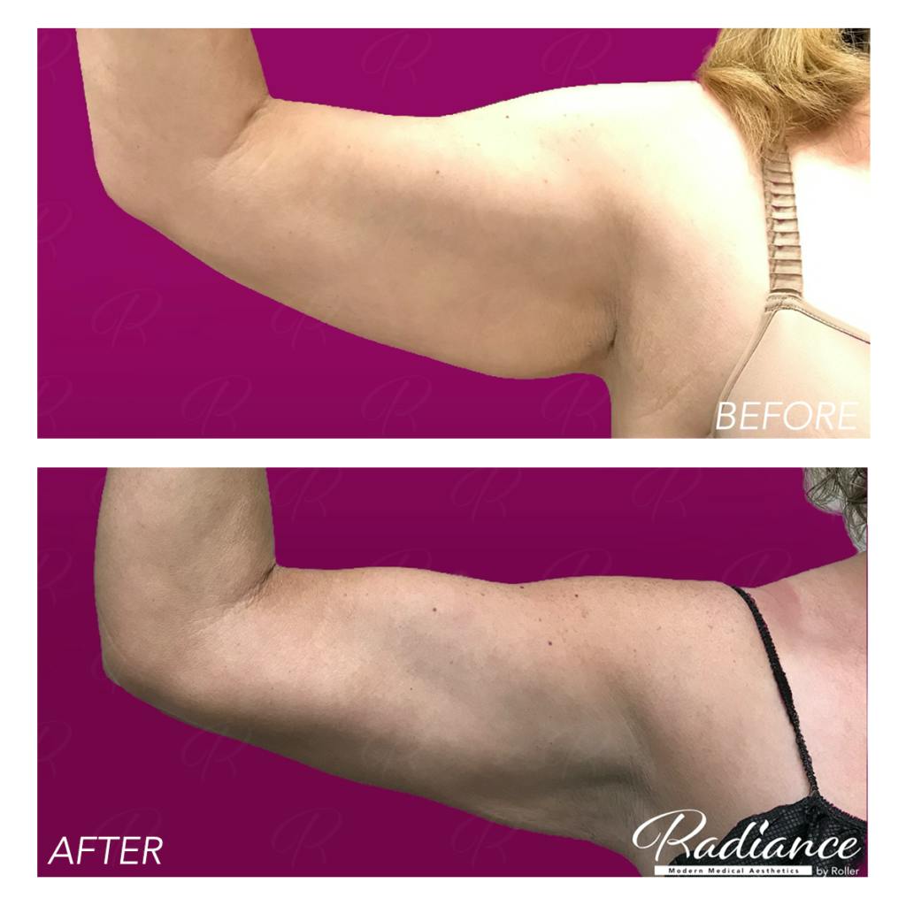 BodyTite Before & After Gallery - Patient 86641407 - Image 6