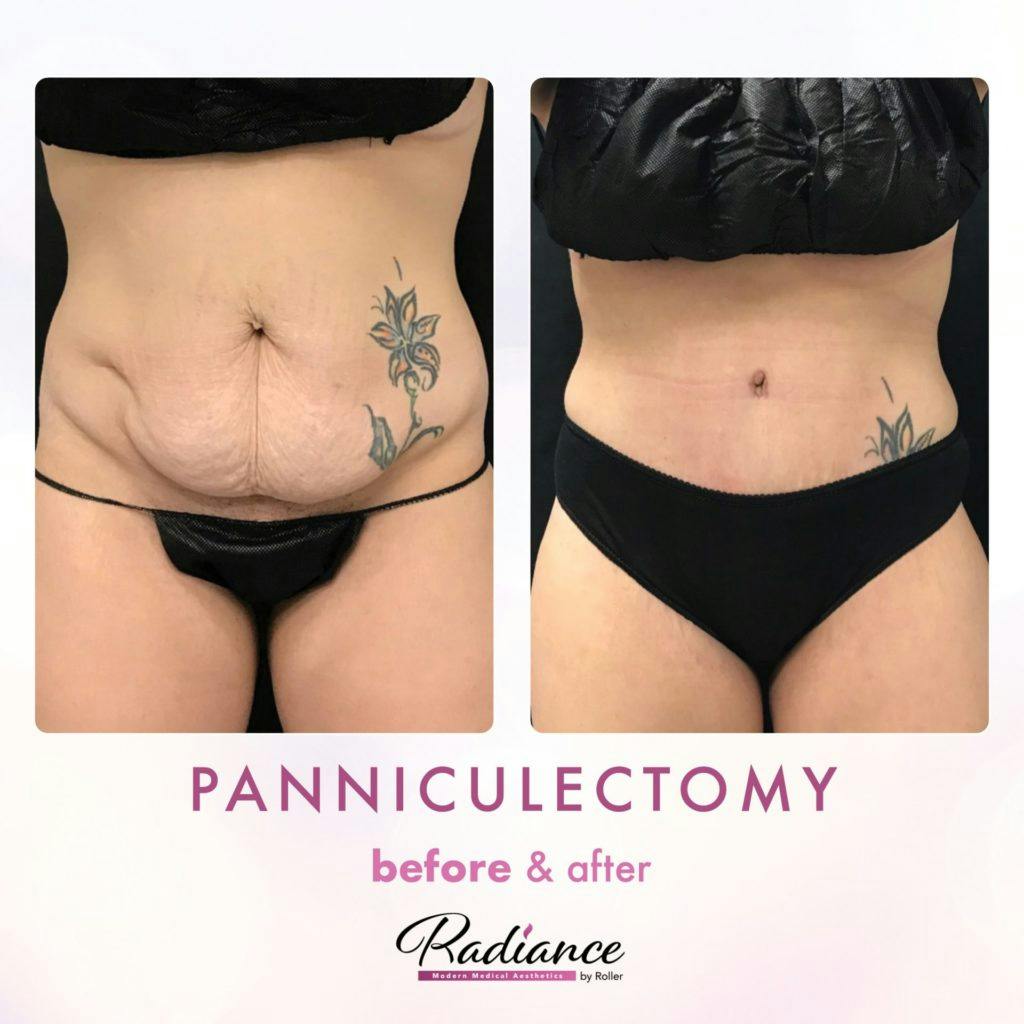 Tummy Tuck and Abdominoplasty Before & After Gallery - Patient 86641426 - Image 1