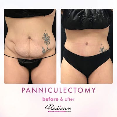 Tummy Tuck and Abdominoplasty Before & After Gallery - Patient 86641426 - Image 1