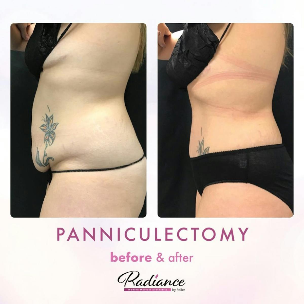 Tummy Tuck and Abdominoplasty Before & After Gallery - Patient 86641426 - Image 2
