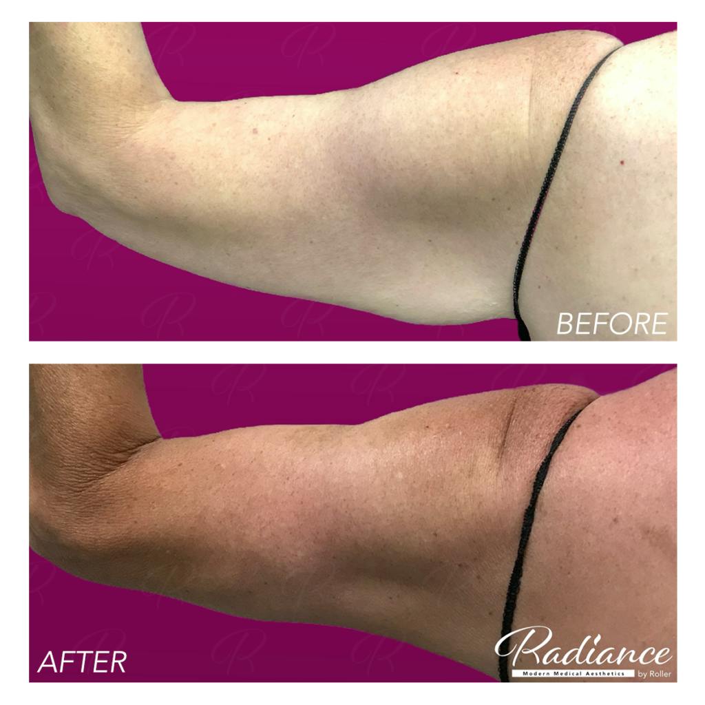 BodyTite Before & After Gallery - Patient 86641407 - Image 7