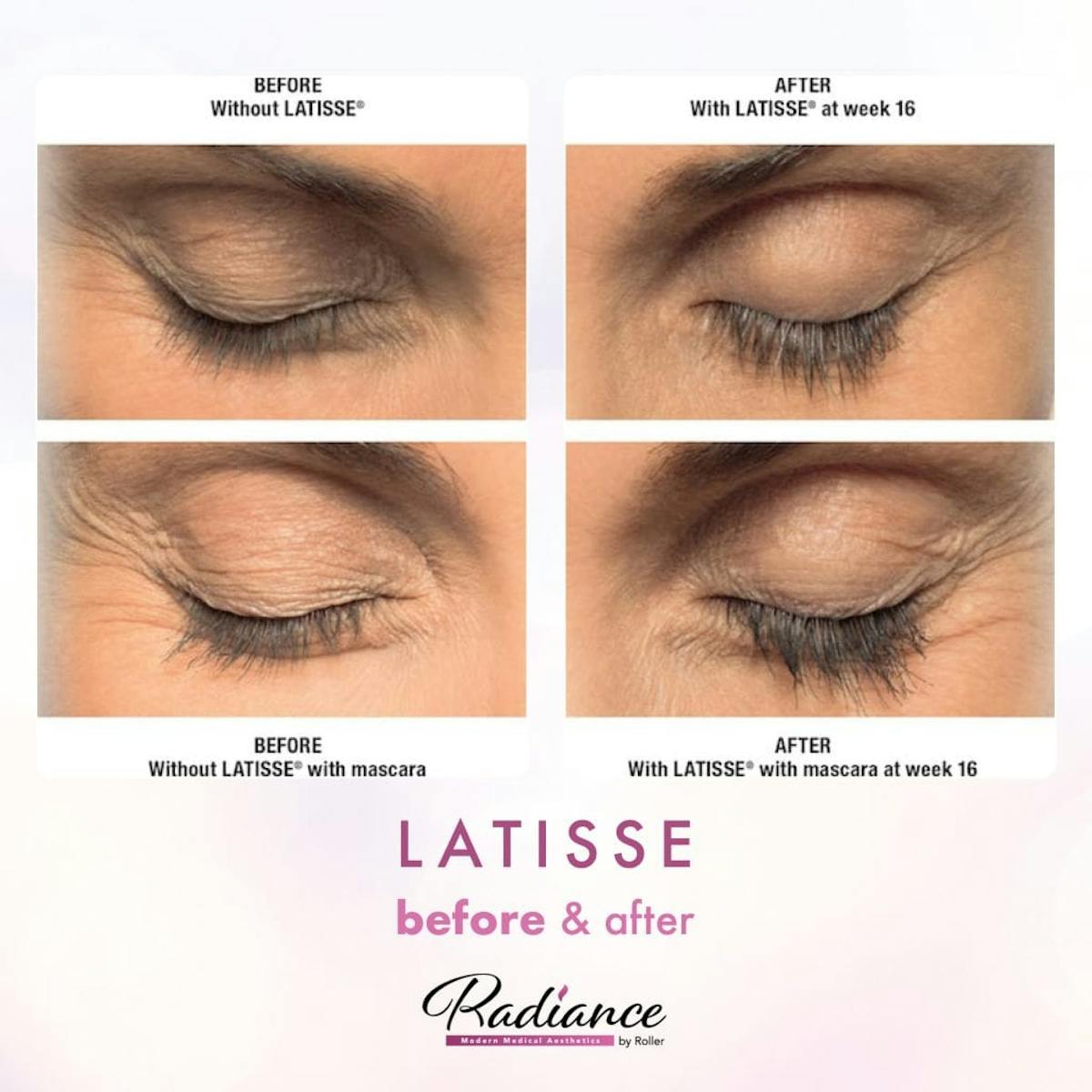 LATISSE® Before & After Gallery - Patient 86641429 - Image 1