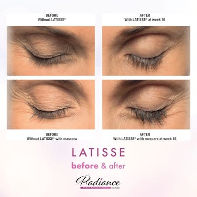 LATISSE® Before & After Gallery - Patient 86641429 - Image 1