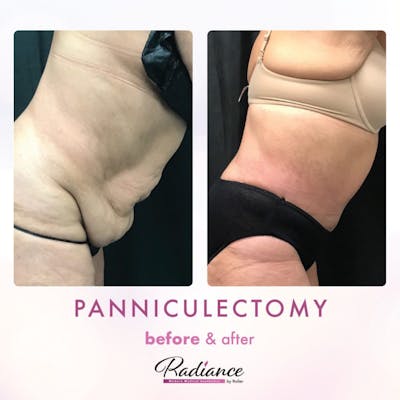 Tummy Tuck and Abdominoplasty Before & After Gallery - Patient 86641430 - Image 1