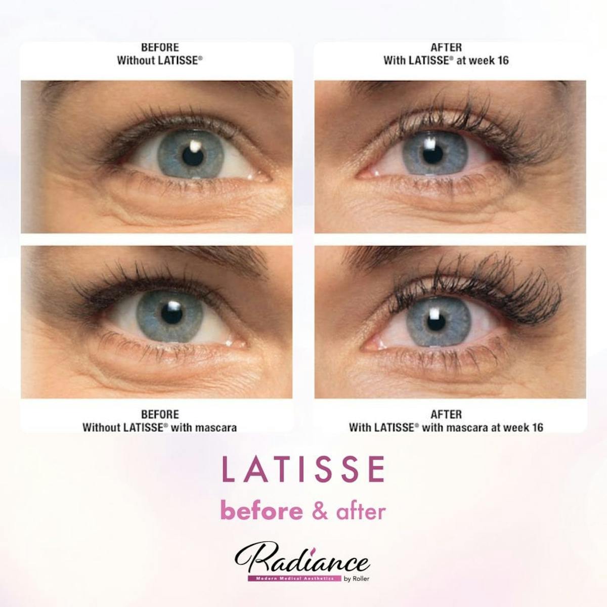 LATISSE® Before & After Gallery - Patient 86641432 - Image 1