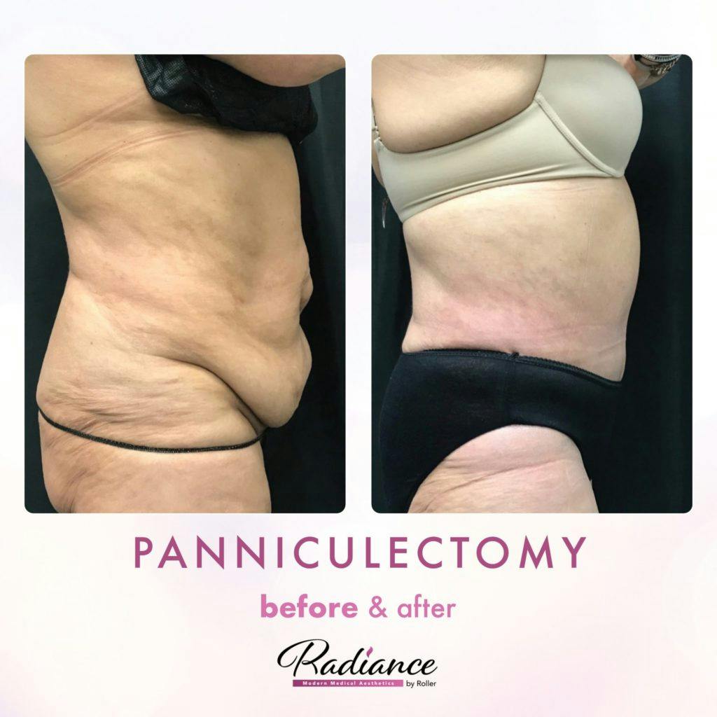 Tummy Tuck and Abdominoplasty Before & After Gallery - Patient 86641430 - Image 2