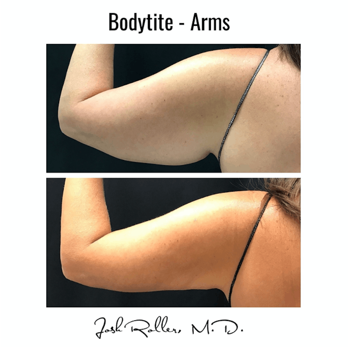 BodyTite Before & After Gallery - Patient 86641434 - Image 1