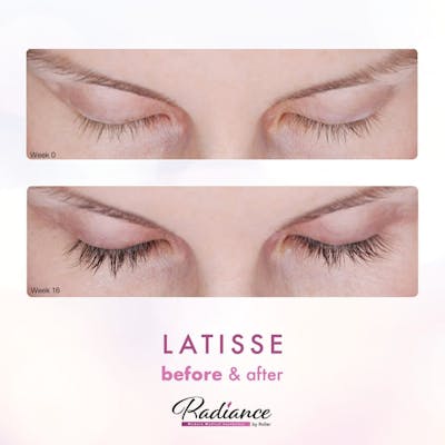 LATISSE® Before & After Gallery - Patient 86641435 - Image 1