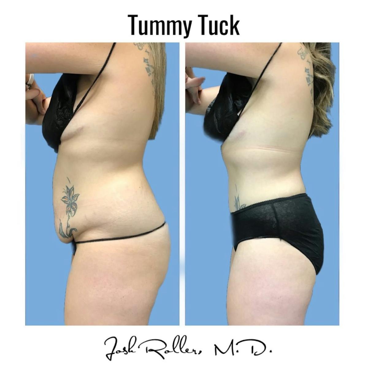 Tummy Tuck and Abdominoplasty Before & After Gallery - Patient 86641426 - Image 3