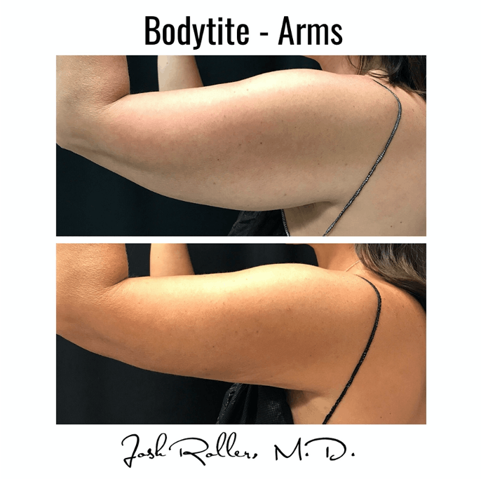 BodyTite Before & After Gallery - Patient 86641434 - Image 2