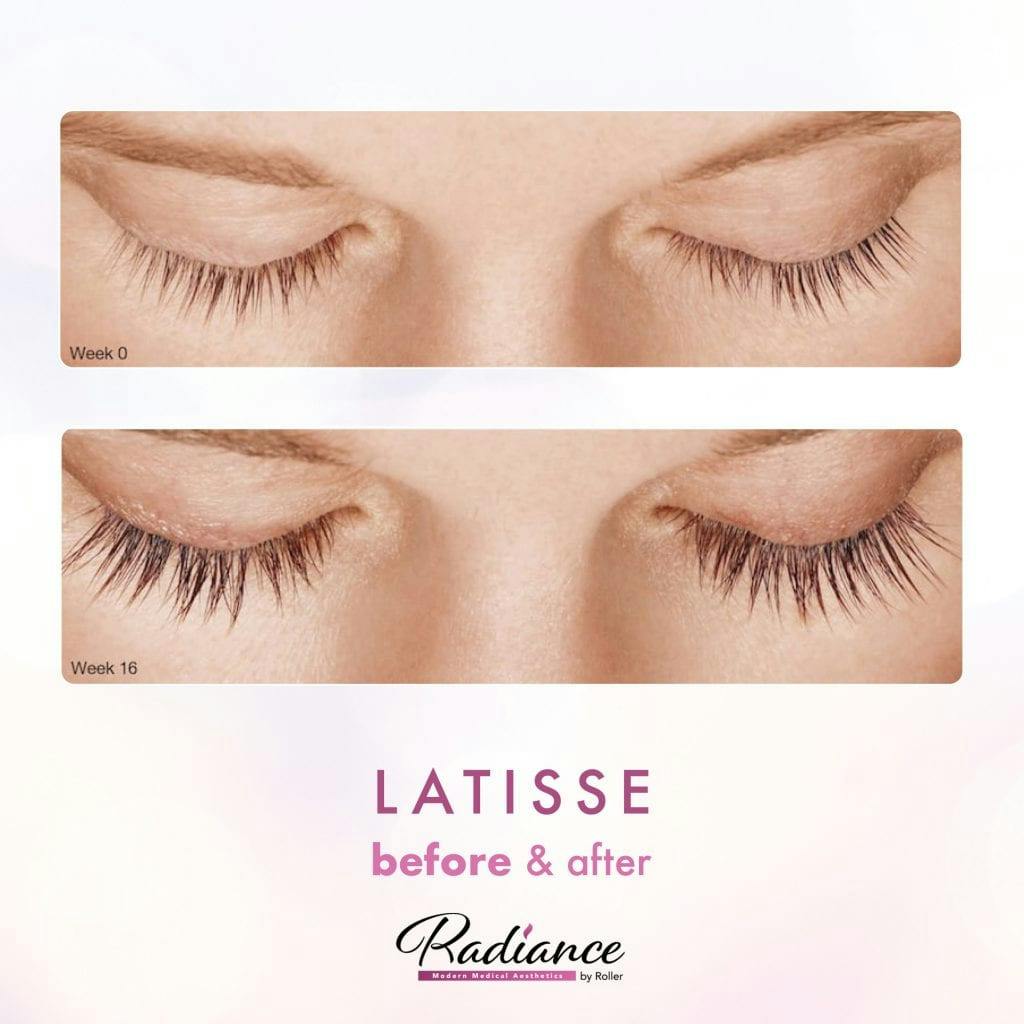 LATISSE® Before & After Gallery - Patient 86641437 - Image 1