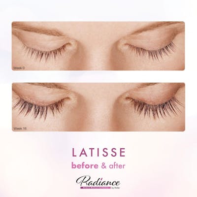 LATISSE® Before & After Gallery - Patient 86641437 - Image 1
