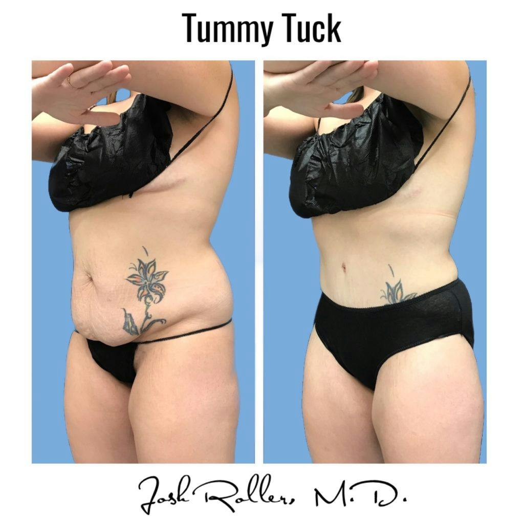 Tummy Tuck and Abdominoplasty Before & After Gallery - Patient 86641426 - Image 4