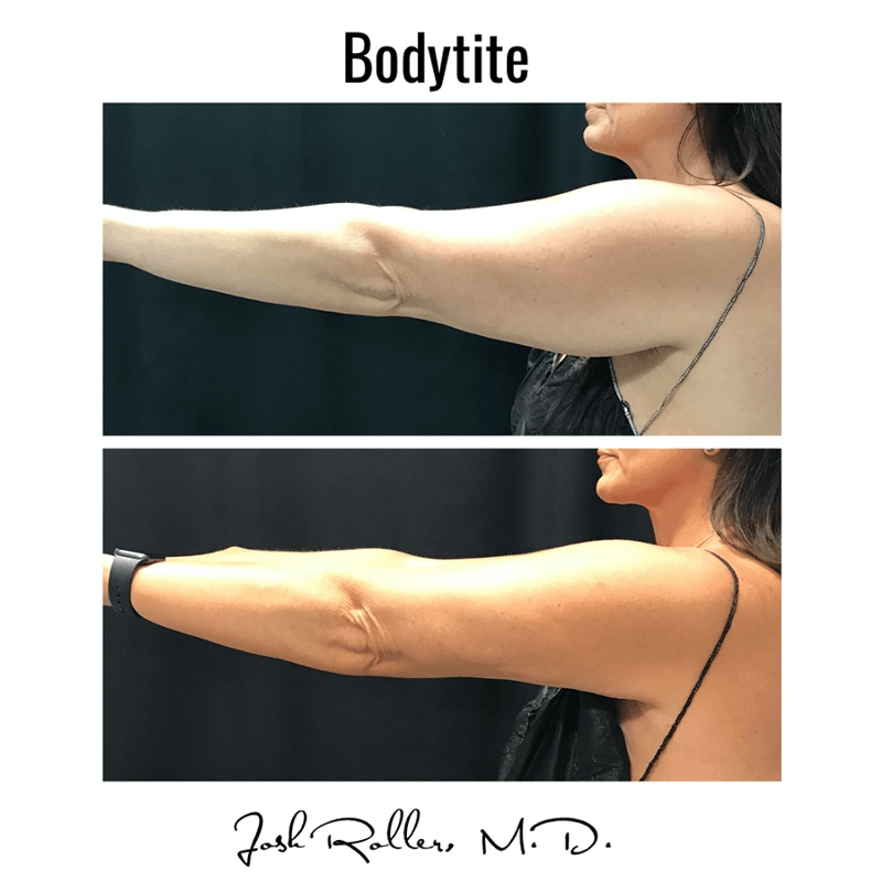 BodyTite Before & After Gallery - Patient 86641434 - Image 3