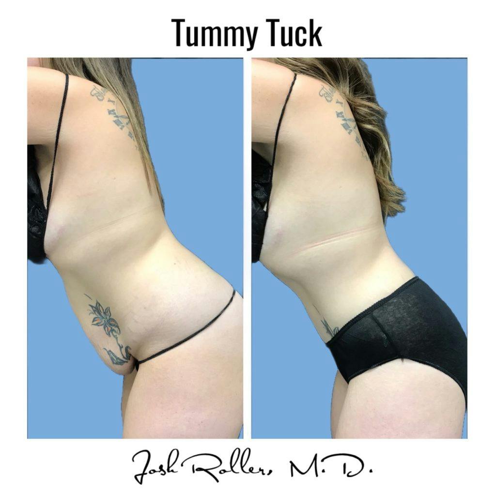 Tummy Tuck and Abdominoplasty Before & After Gallery - Patient 86641426 - Image 5