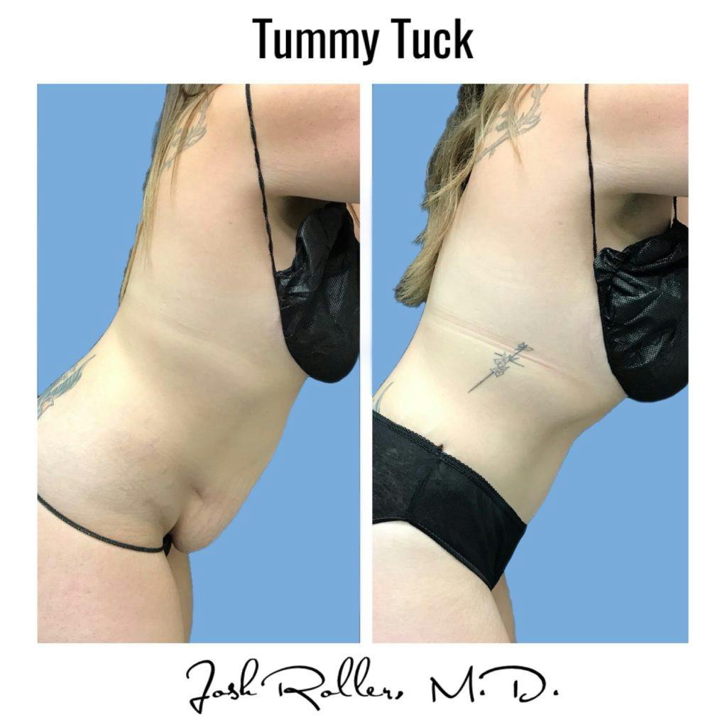 Tummy Tuck and Abdominoplasty Before & After Gallery - Patient 86641426 - Image 6