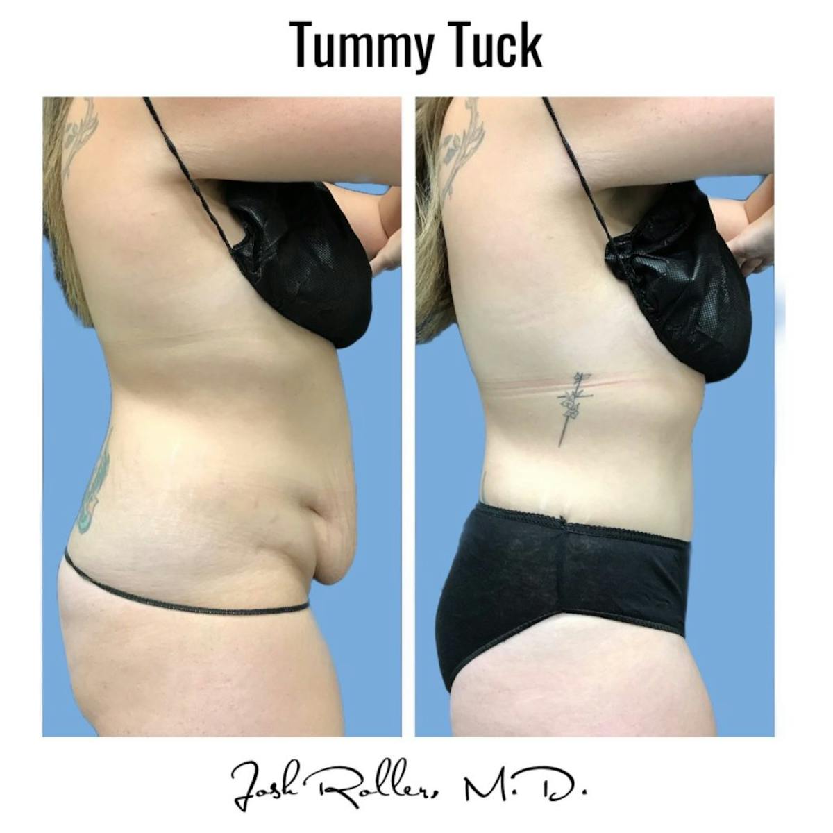 Tummy Tuck and Abdominoplasty Before & After Gallery - Patient 86641426 - Image 7