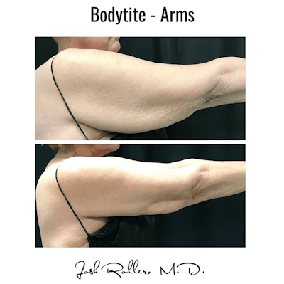BodyTite Before & After Gallery - Patient 86641446 - Image 1