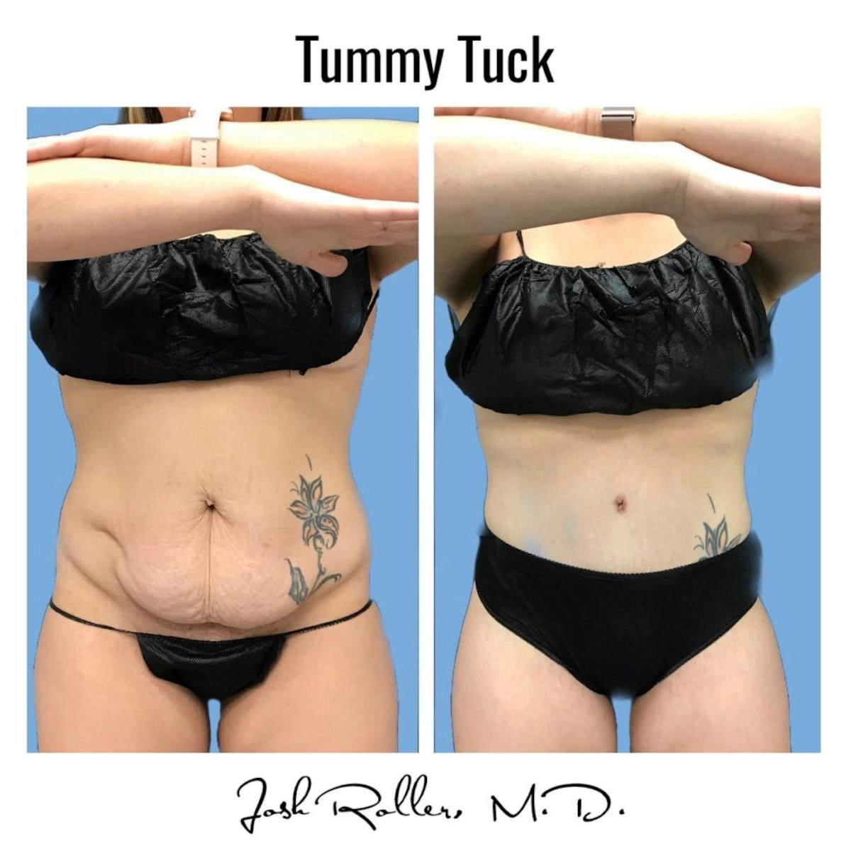Tummy Tuck and Abdominoplasty Before & After Gallery - Patient 86641426 - Image 8
